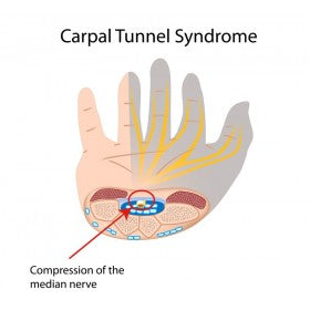 What Is Carpal Tunnel Syndrome? Anatomy, Symptoms & Treatment Discusse ...